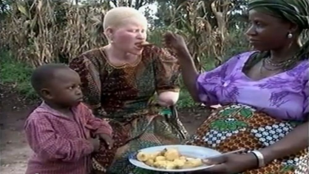 L&#039;albinisme en Tanzanie, source UN.org