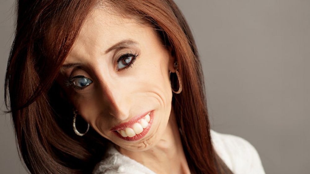 Lizzie Velasquez est atteinte d&#039;un syndrome rarissime