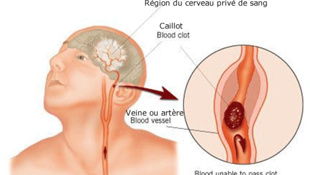 Qu&#039;est-ce qu&#039;un Accident Vasculaire C&eacute;r&eacute;bral ?